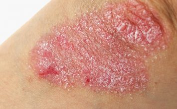 3 Hal tentang Psoriasis, Penyakit Kulit yang Belum Banyak Diketahui