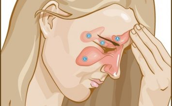 4 Fakta Tentang Sinusitis yang Wajib Kamu Pahami