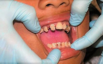 6 Penyakit Ini Muncul Karena Sakit Gigi