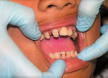 6 Penyakit Ini Muncul Karena Sakit Gigi