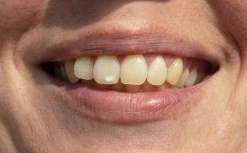 Simak 5 Penyebab Bintik Putih di Gigi