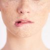 cegah dan kendalikan melasma